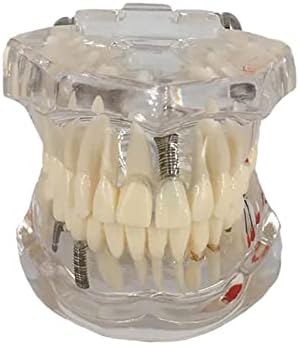 SUZLA Прозрачен Модел на зъбите с Болестта на Зъбни Импланти Модел на Зъбите за Зъболекар Обучение на Студентите-Стоматолози, Обучение,